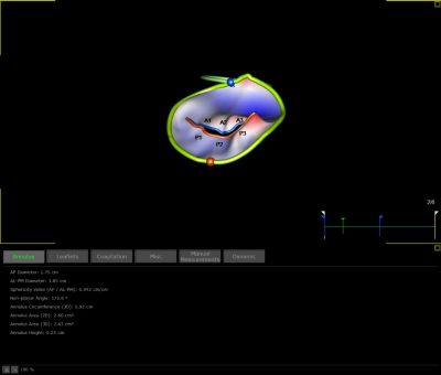 3D echocardiographic image: Mitral valve model